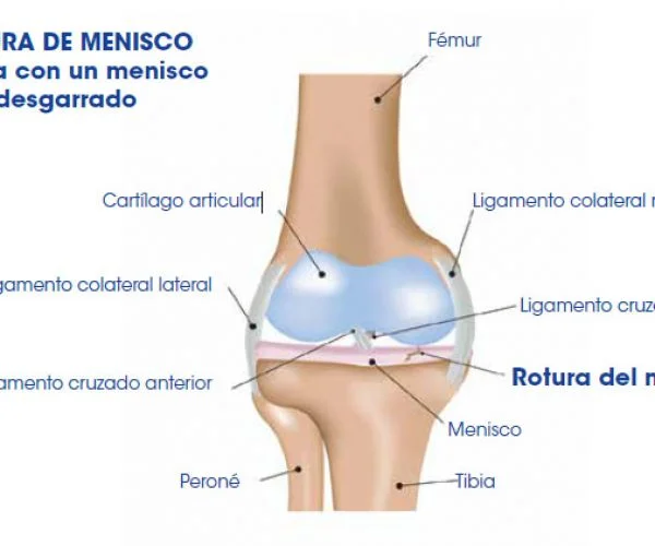 Diferencia entre menisco y cartílago