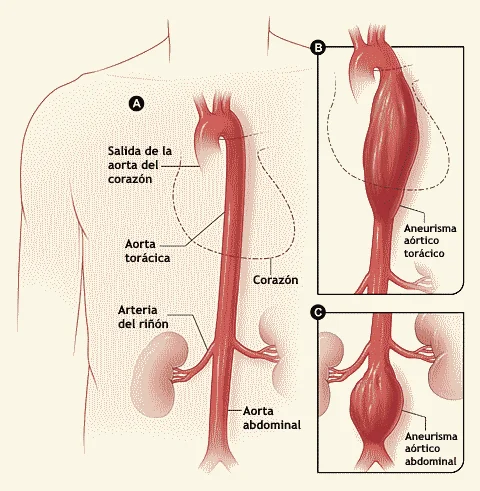 Diferencia entre la dilatación aórtica y el aneurisma