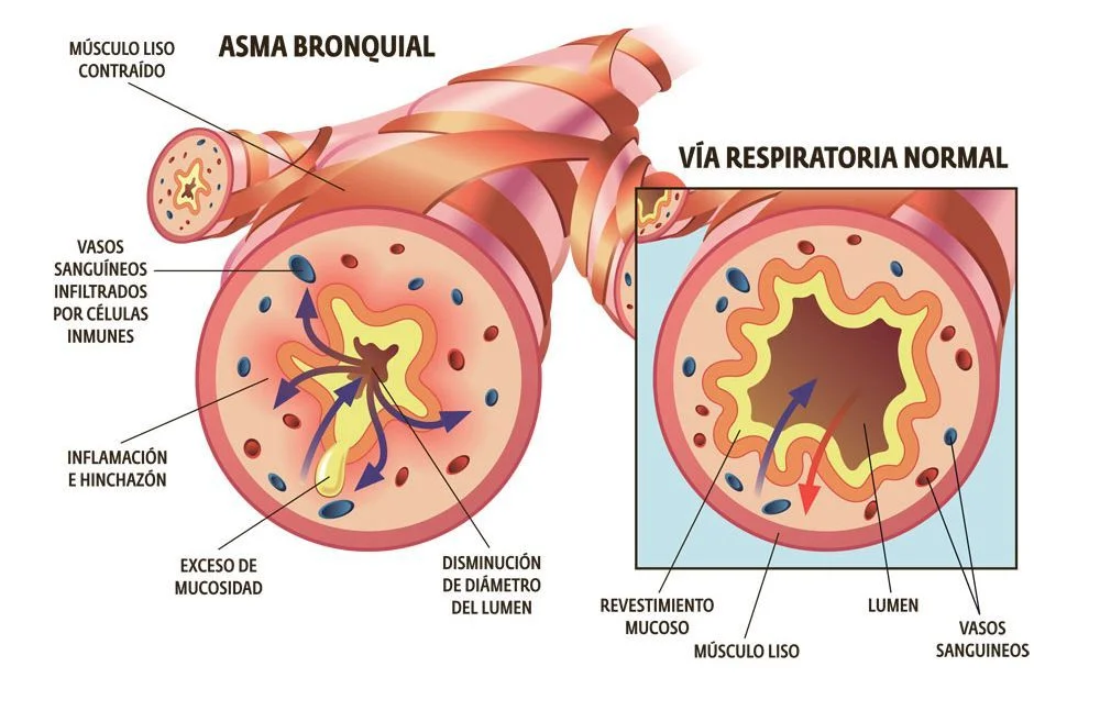Diferencia entre bronquitis y asma