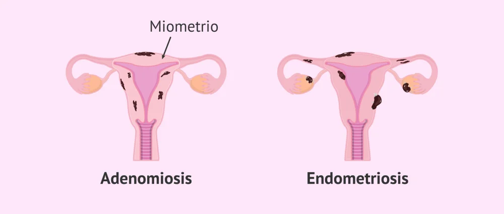 Diferencia entre endometriosis y adenomiosis