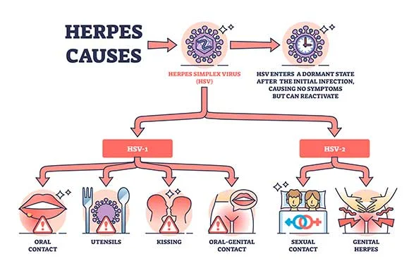 Diferencia entre HSV 1 y HSV 2