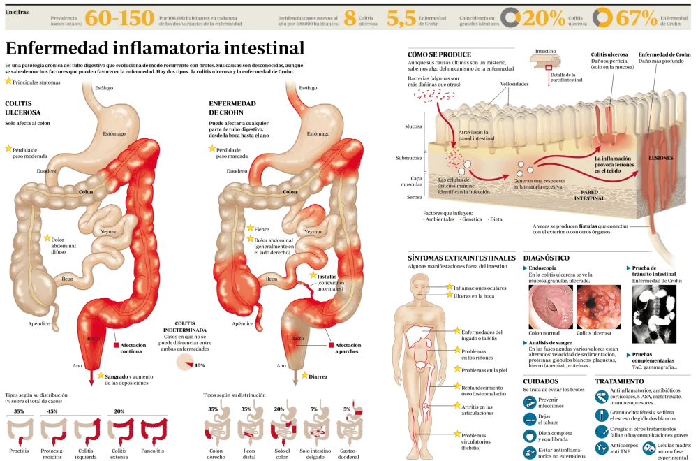 Diferencia entre la enfermedad de Crohn y la colitis ulcerosa