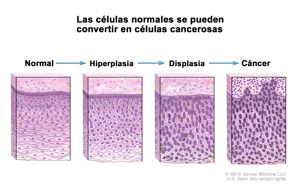 Diferencia entre metaplasia y displasia