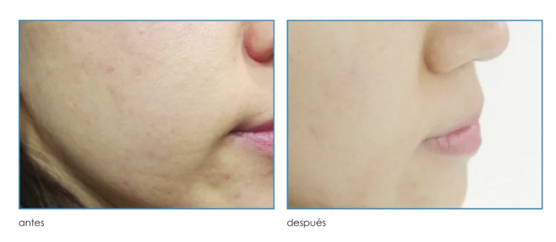 Diferencia entre un tratamiento facial y una limpieza