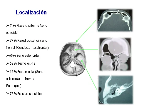 Diferencia entre el LCR y la secreción nasal