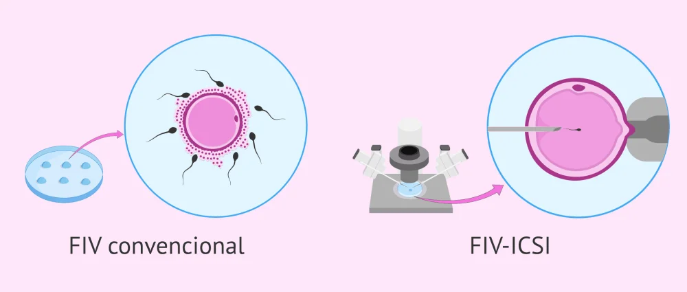 Diferencia entre ICSI y FIV