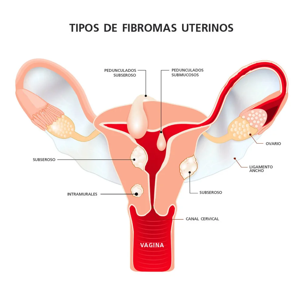 Diferencia entre quiste y pólipo