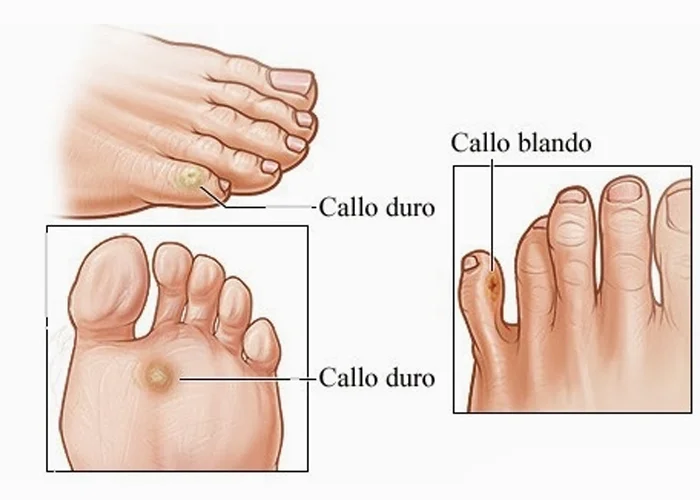 Diferencia entre callo y plántula