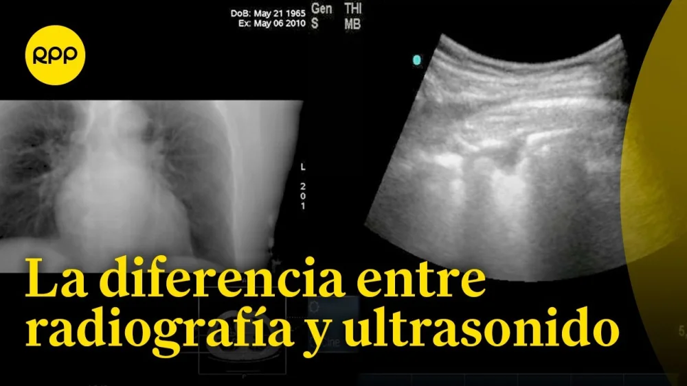 Diferencia entre rayos X y ultrasonido
