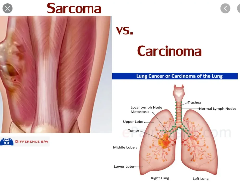 Diferencia entre cáncer y sarcoma
