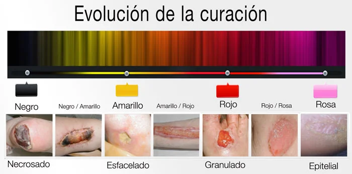 Diferencia entre epitelización y granulación