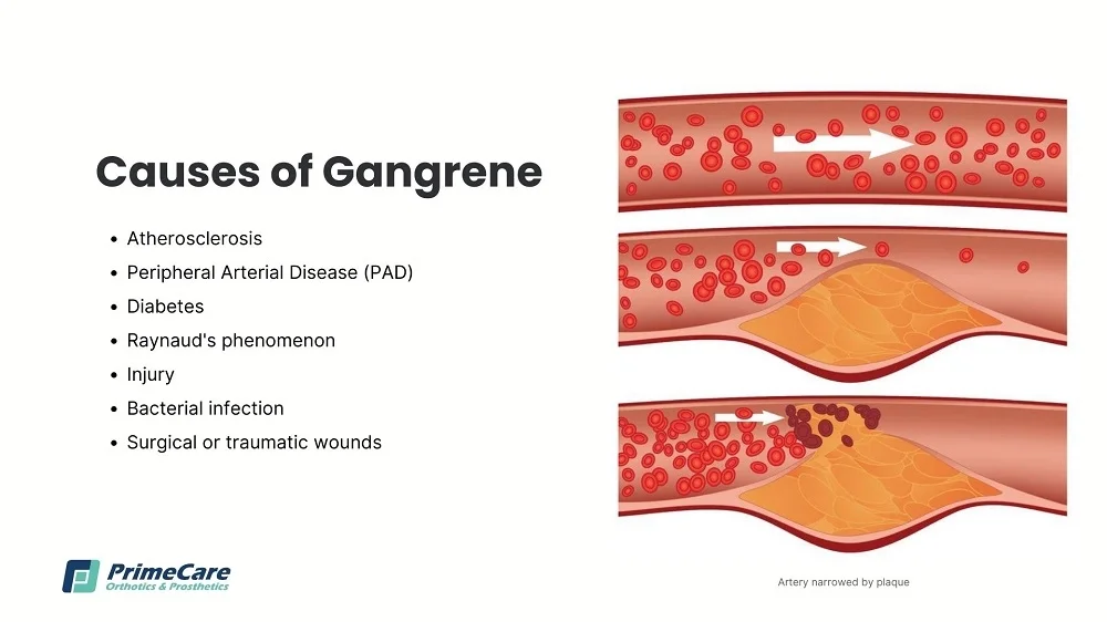 Diferencia entre gangrena seca y húmeda