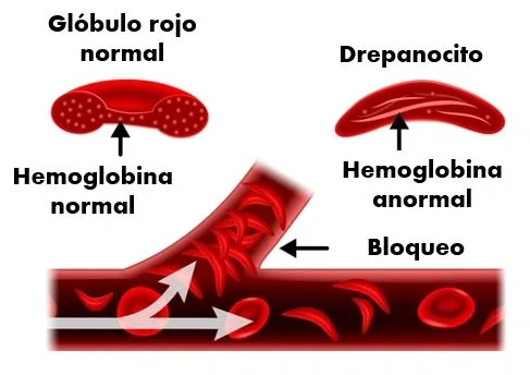 Diferencia entre la hemoglobina normal y la hemoglobina falciforme