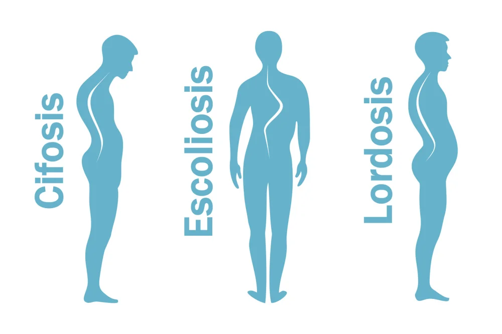 Diferencia entre escoliosis cifosis y lordosis
