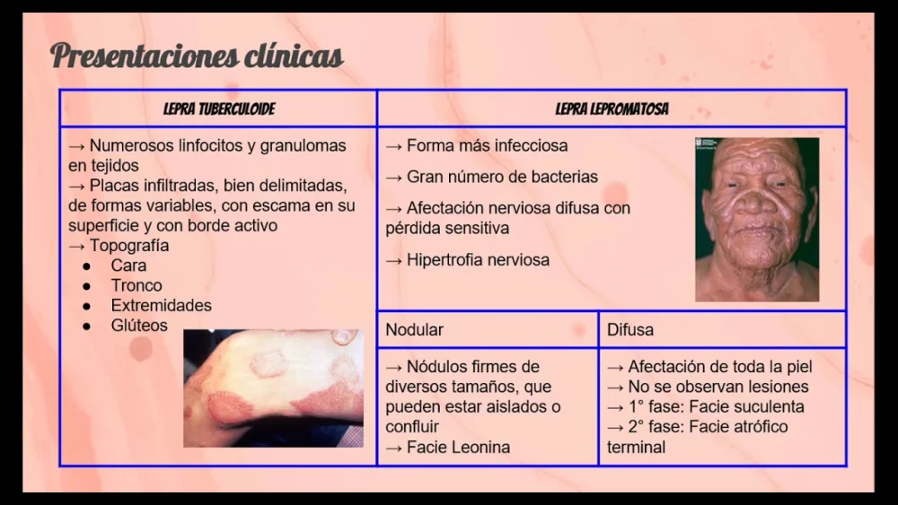 Diferencia entre la lepra tuberculoide y la lepromatosa