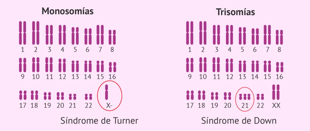 Diferencia entre monosomía y trisomía