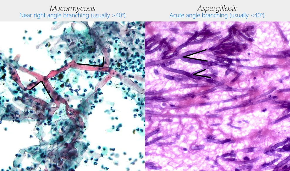 Diferencia entre Mucor y Aspergillus