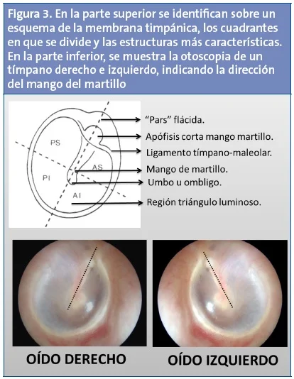 Diferencia entre la membrana timpánica derecha e izquierda