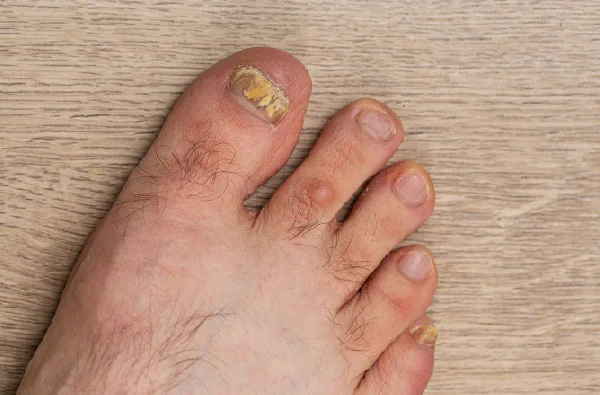 ¿Qué causa los hongos en las uñas de los pies? ¿Cómo tratarlos?