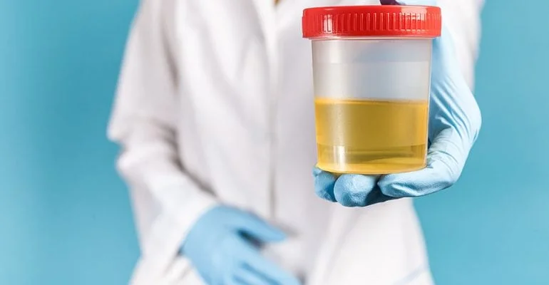¿Qué causa los niveles altos de cortisol en la orina?
