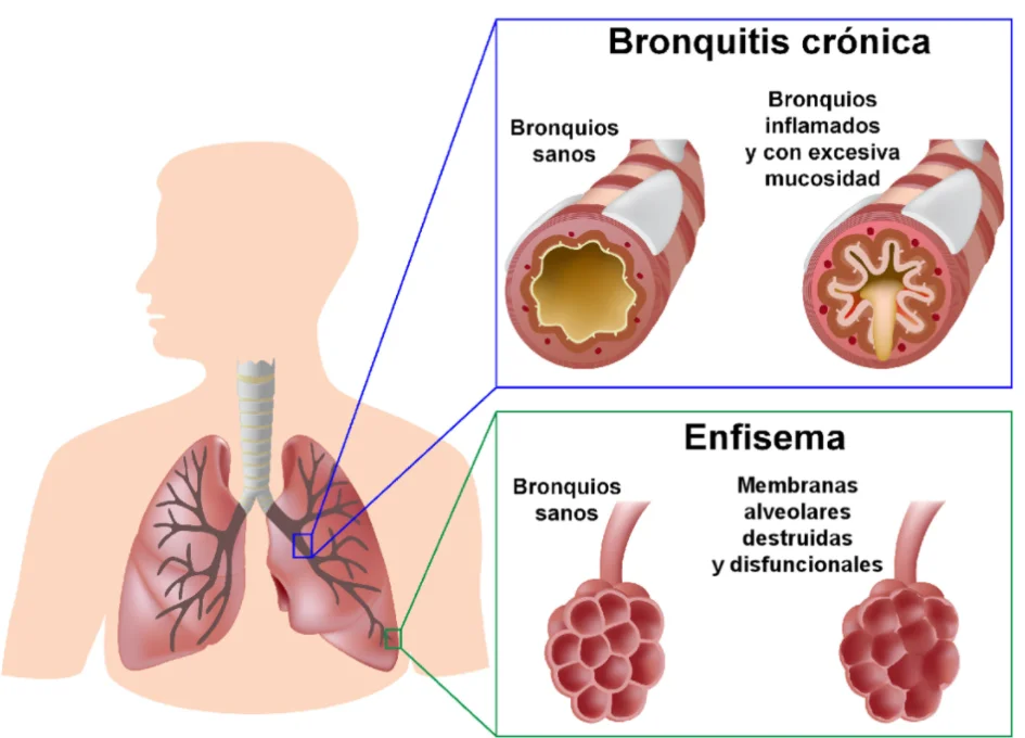 ¿Qué es el enfisema y cómo se trata?