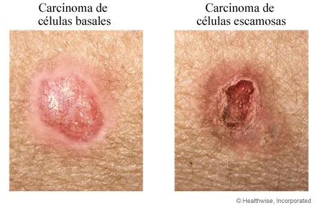 Diferencia entre células basales y células escamosas