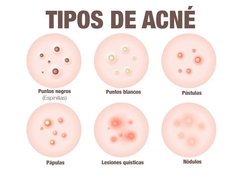 Diferencia entre grano y espinilla