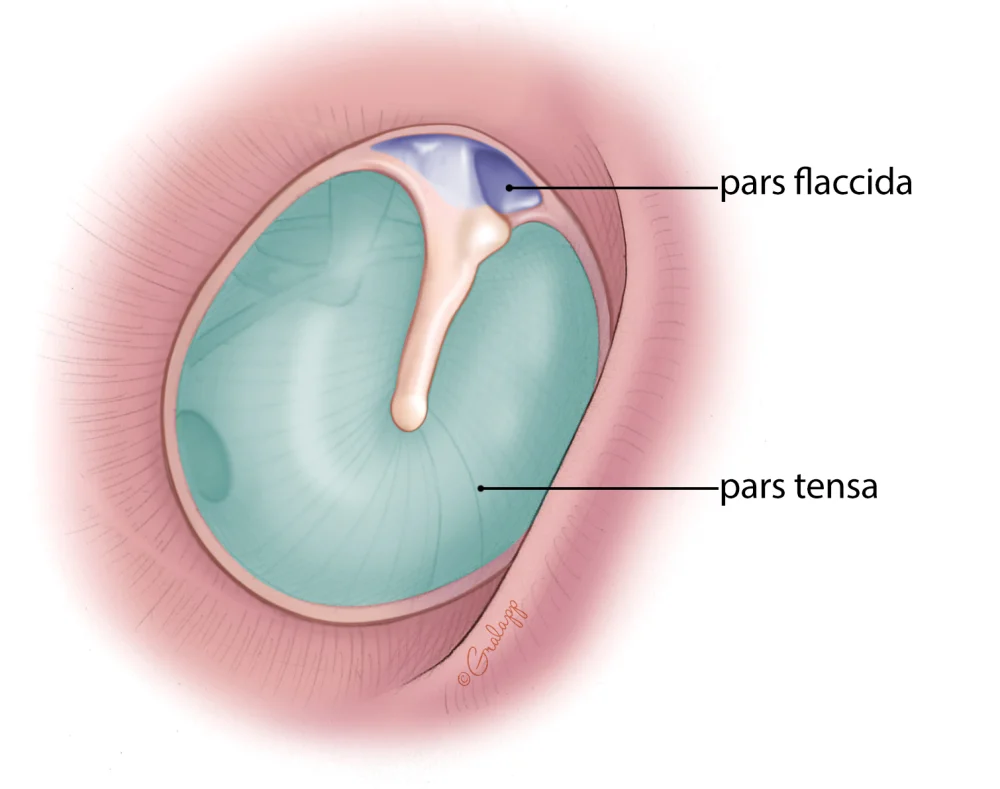 Diferencia entre la pars tensa y la pars flácida