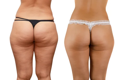 Diferencia entre celulitis y grasa