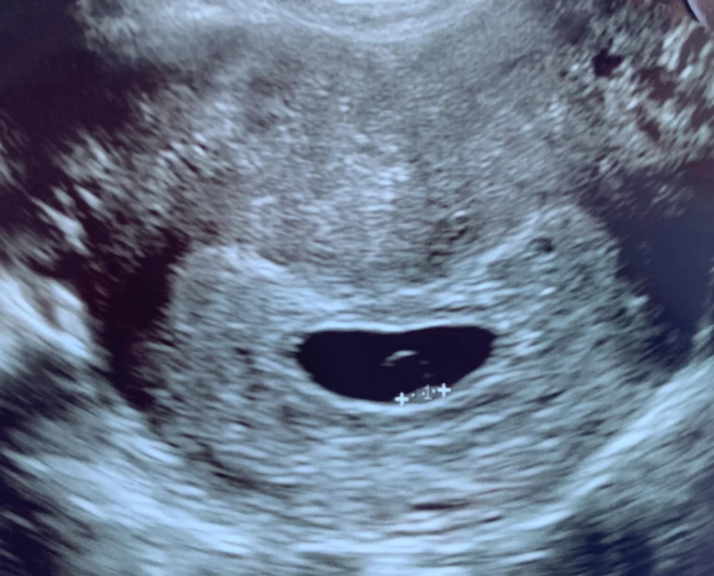 Diferencia entre el saco vitelino y el polo fetal