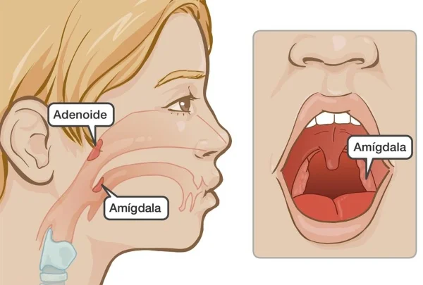 Diferencia entre adenoides y amígdalas Ciencia