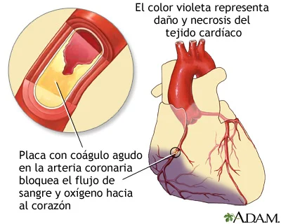¿Qué es un infarto de miocardio? ¿Qué causa un infarto de miocardio?