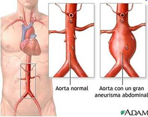 Diferencia entre la aorta torácica y la abdominal