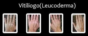 Diferencia entre vitíligo y leucodermia