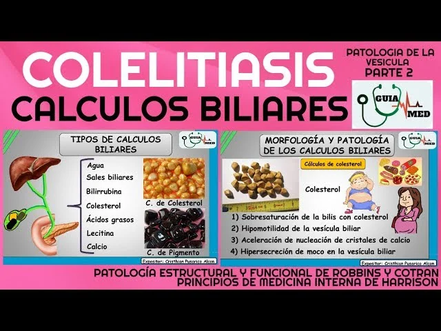 Diferencia entre el colesterol y los cálculos biliares pigmentados