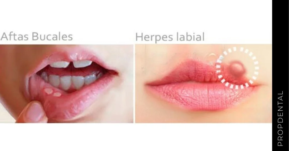 Diferencia entre herpes labial y aftas bucales
