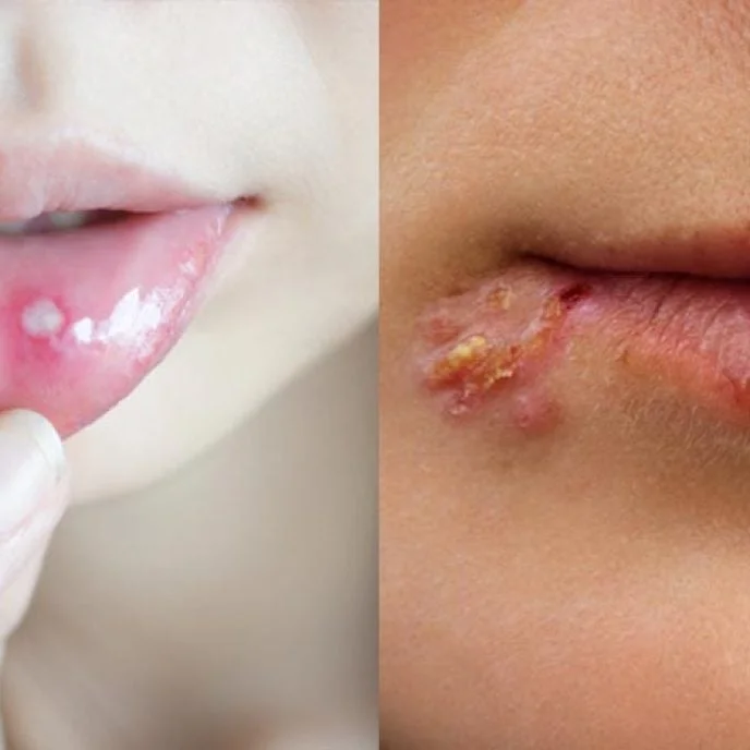 Diferencia entre herpes labial y ampolla febril