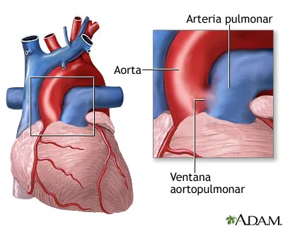 Diferencia entre la aorta y la arteria pulmonar