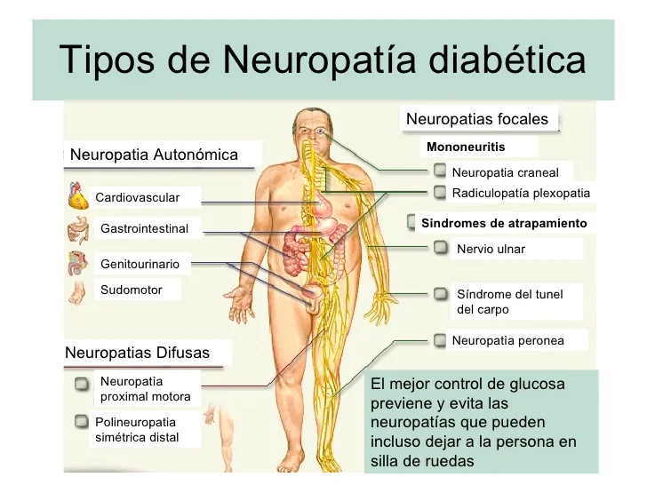 ¿Qué otras causas de la neuropatía además de la diabetes?