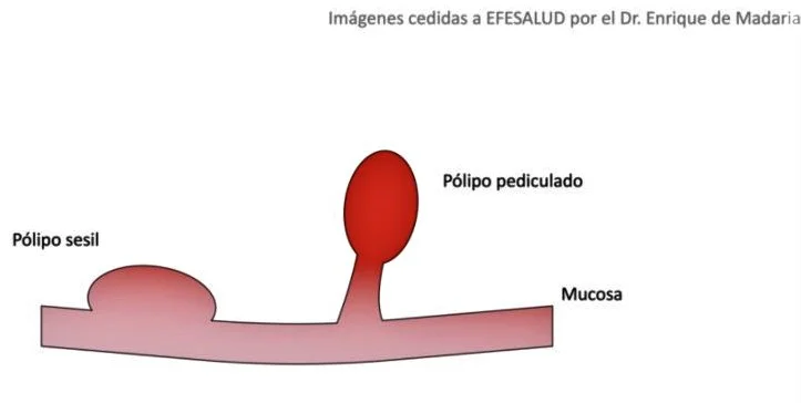 Diferencia entre sésil y móvil