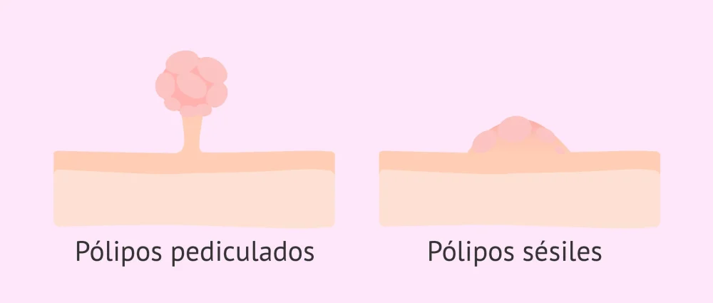 Diferencia entre sésil y pedunculado