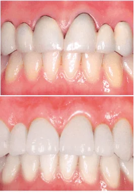Diferencia entre zirconia y porcelana