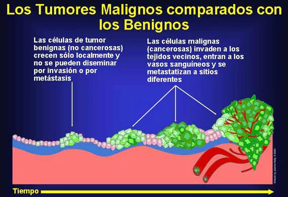 Diferencia entre benigno y maligno