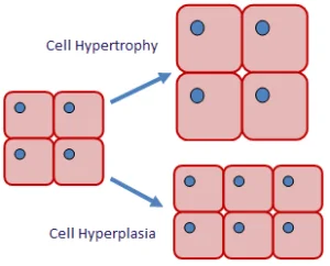 Diferencia entre hiperplasia e hipertrofia
