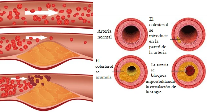 Diferencia entre colesterol y triglicéridos