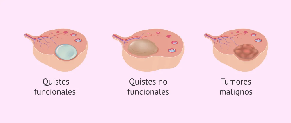 Diferencia entre óvulos y quistes
