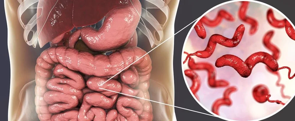 Diferencia entre oxiuros y lombrices intestinales