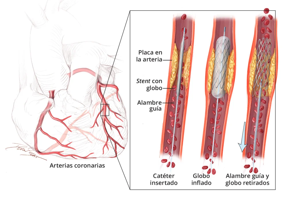 Diferencia entre stent y catéter
