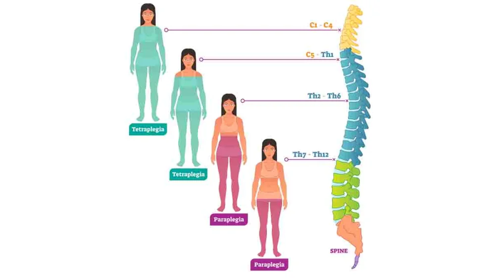 Diferencia entre paraplejía y tetraplejía