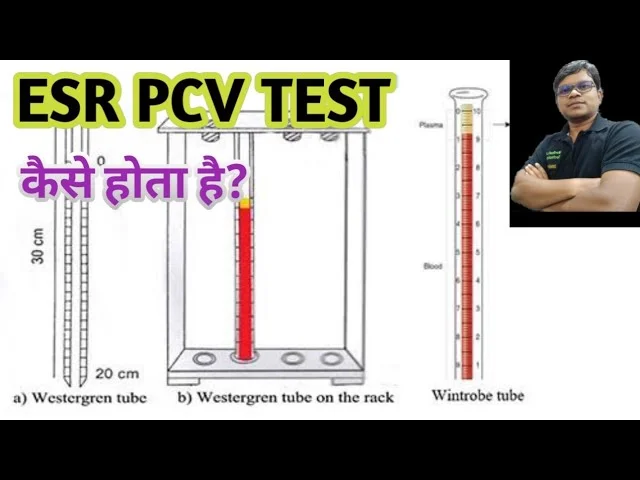 Diferencia entre PCV y ESR